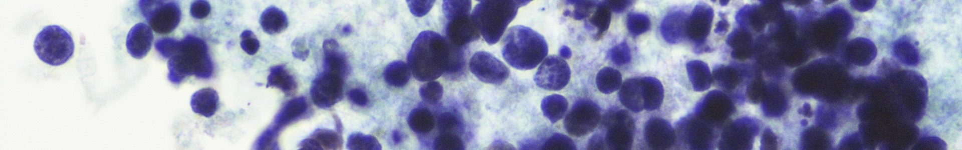 Lung cancer